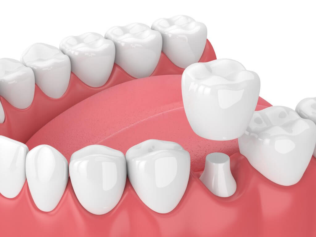 Dental Inlays, Onlays and Crowns