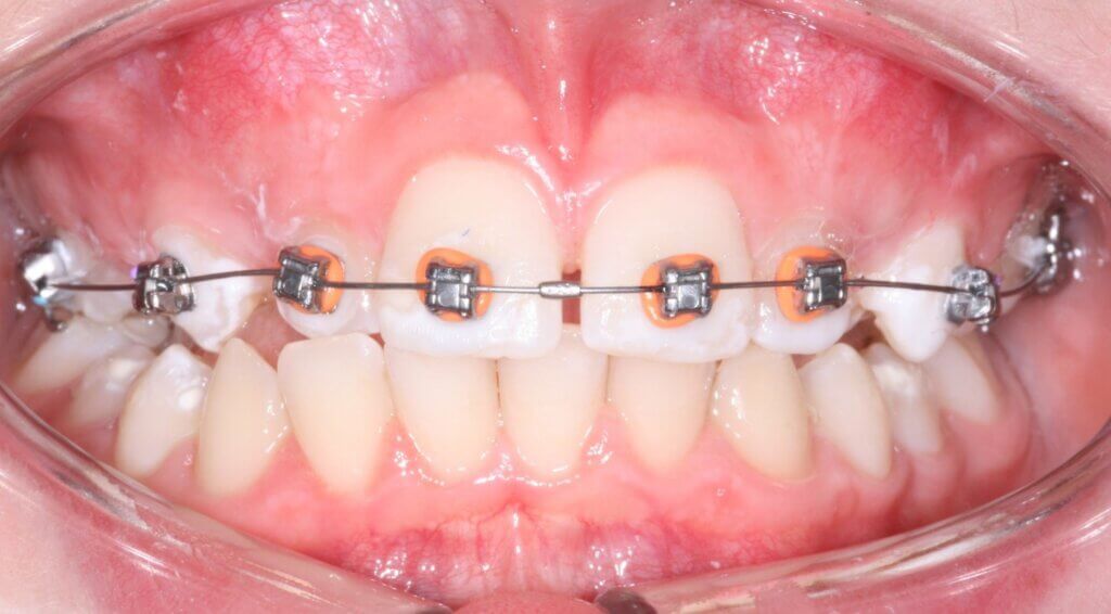 Braces fitted